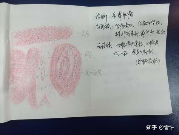 九,平滑肌瘤