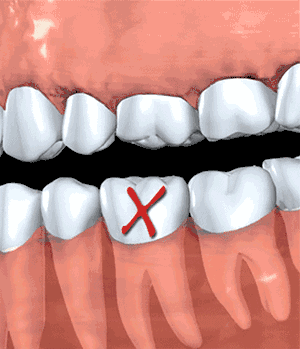 4,导致牙齿龋坏