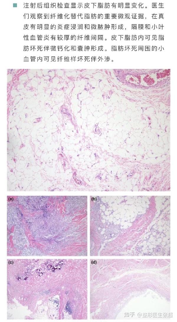 医生们观察到纤维化替代脂肪的重要微观证据,在真皮有明显的炎症浸润
