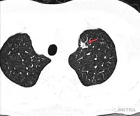 肺结节读片(7:空泡的意义