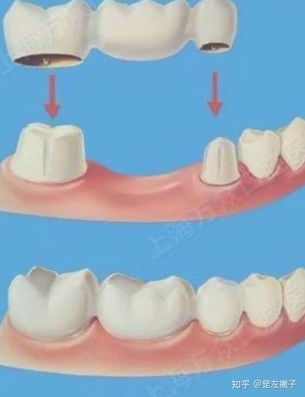 拔牙拔牙拔牙一个恐怖的经历