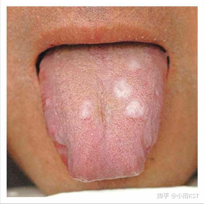 正常舌象舌色淡红鲜明,舌质滋润,舌体大小适中,柔软灵活自如,老嫩胖瘦
