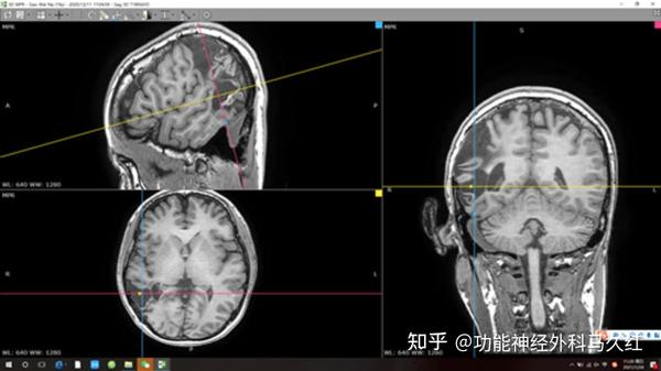 癫痫序列的颅脑磁共振,发现其外伤后局部软化灶