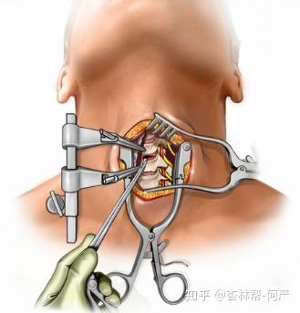 7,什么样的颈椎病患者需要做融合和内固定?手术是否需要植入新骨吗?
