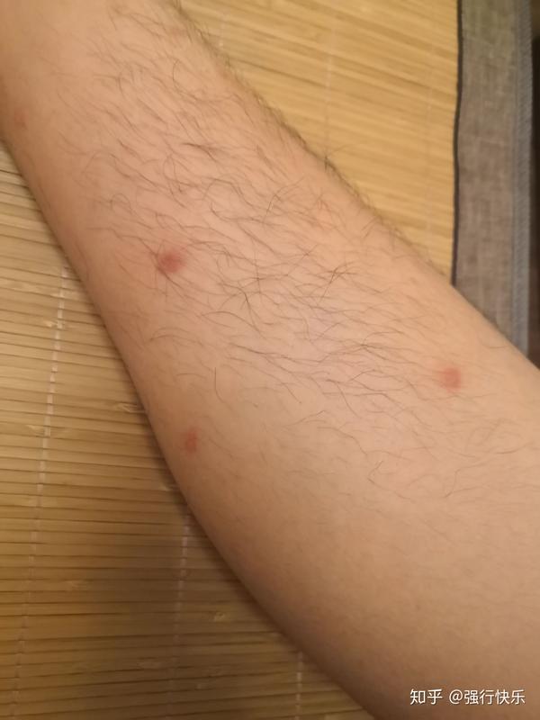 身上起红疙瘩很痒