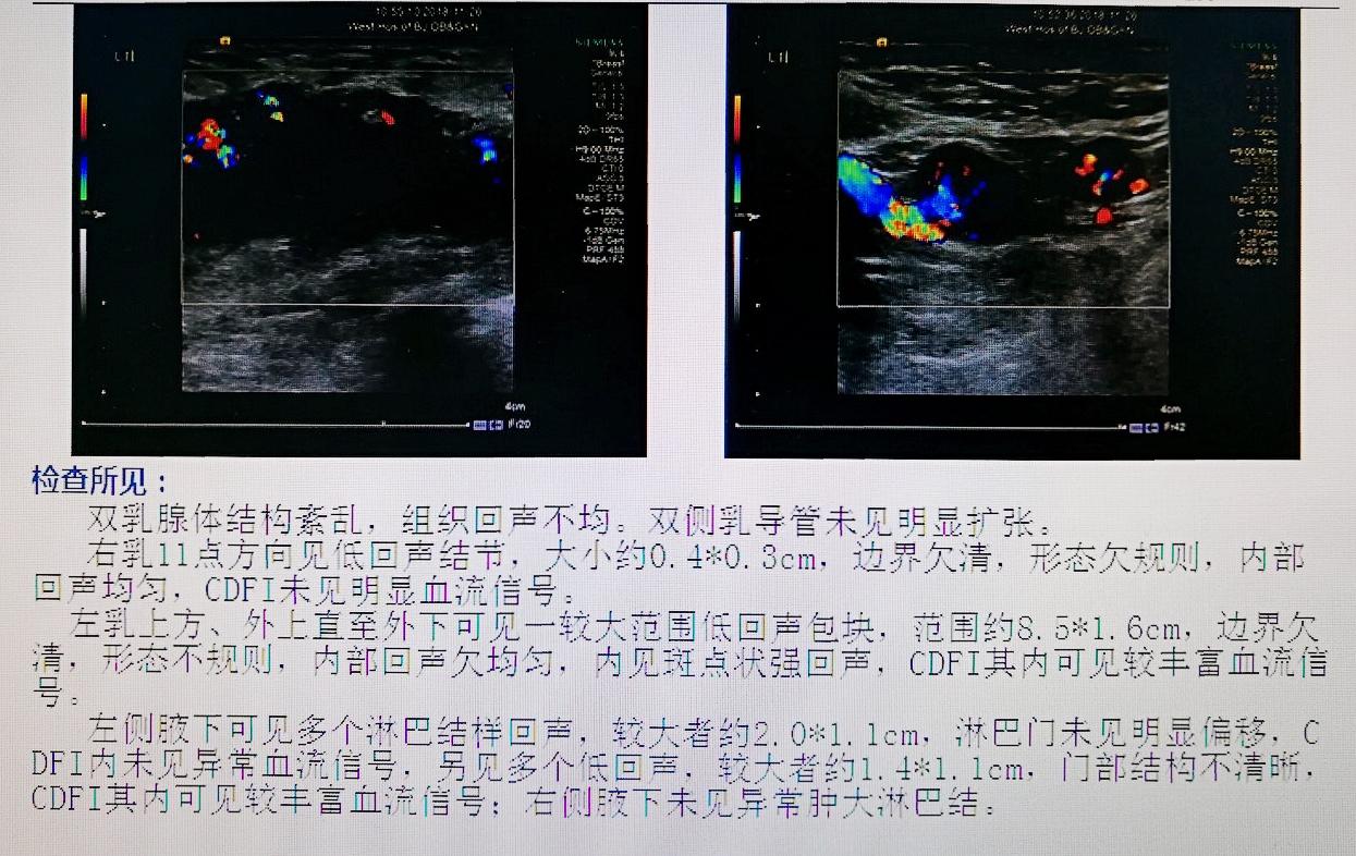 乳腺b超报告里隐藏的宝藏,这一篇教你怎么探宝!