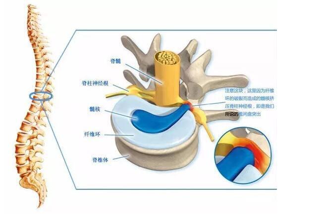 椎间盘突出术后康复训练计划(完整篇 知乎