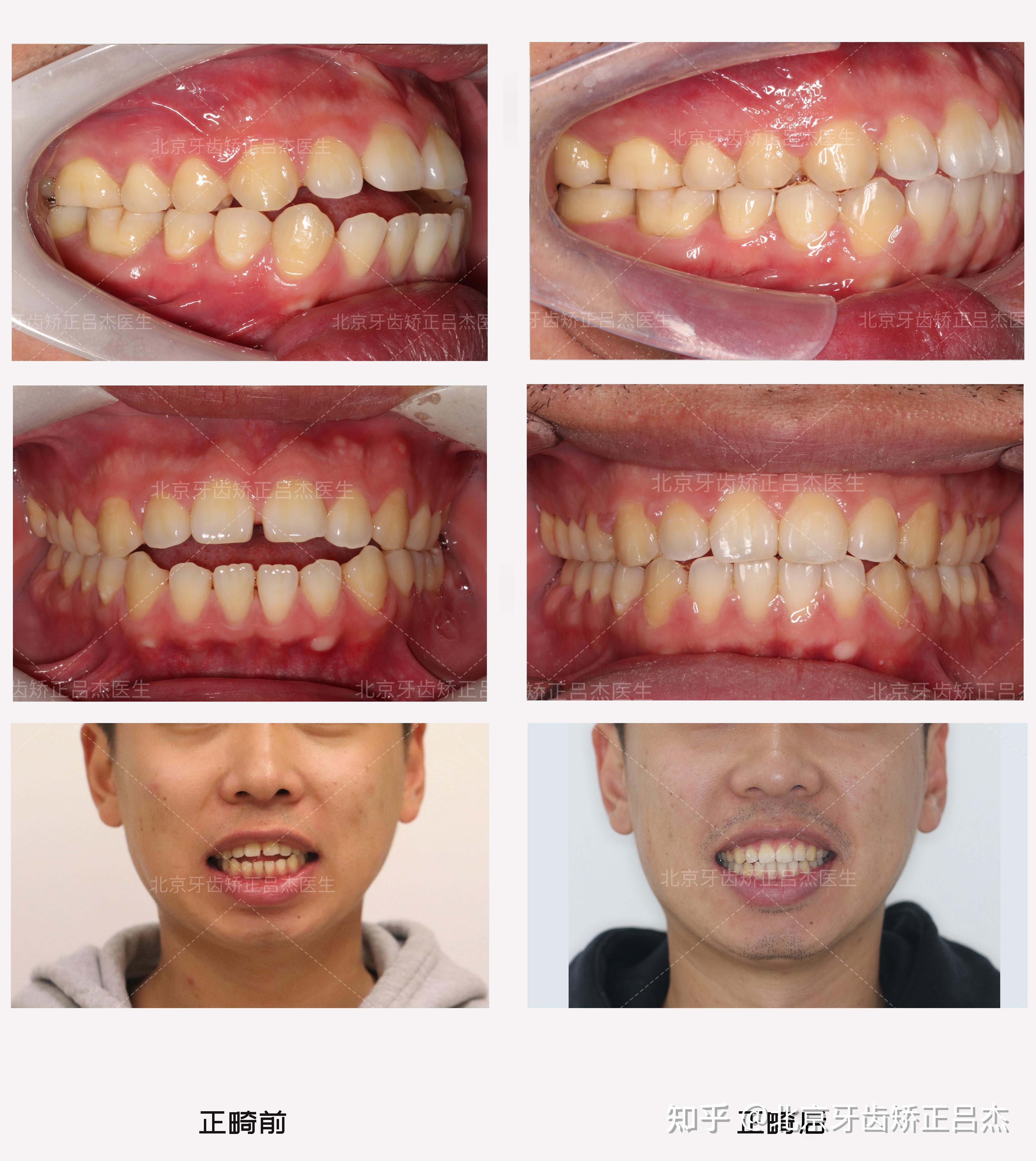 牙齿矫正 | 开颌矫正要多久?