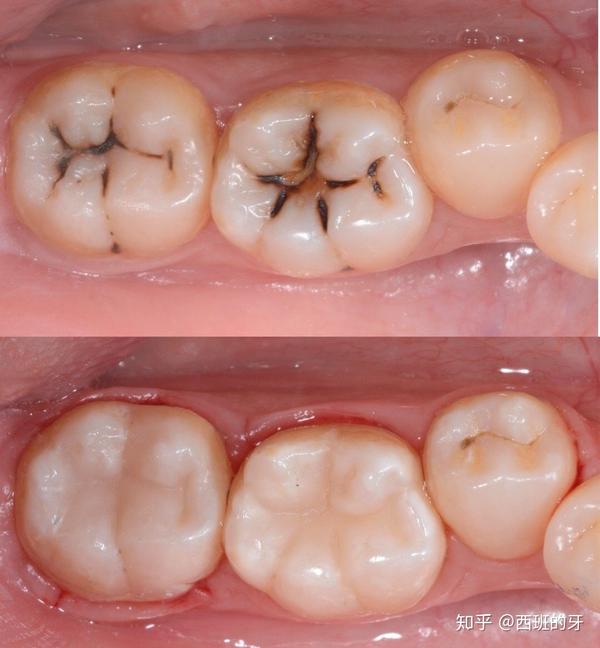 4,牙齿形态,色泽将直接影响面部的美观,尤其是前牙缺损,补牙能恢复