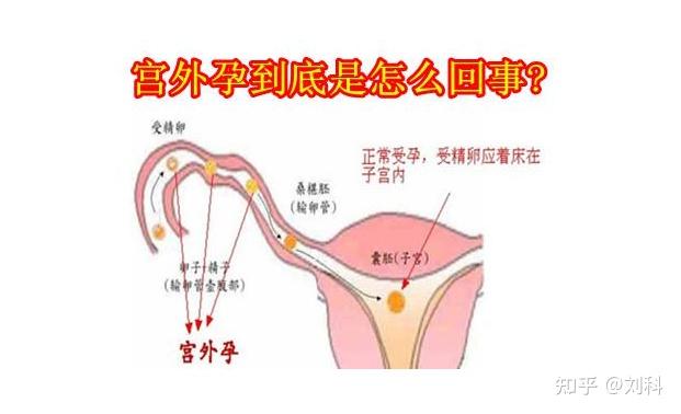 宫外孕有哪些症状