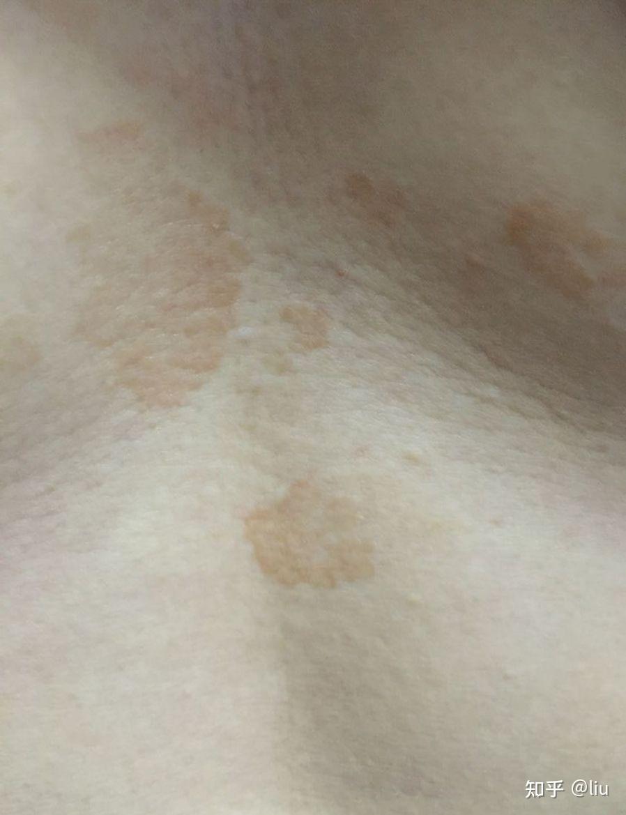 胸前中间长了一片褐色圆斑是什么