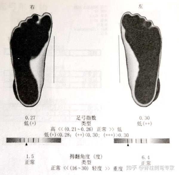 轻度扁平足