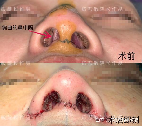 手术方案:矫正鼻中隔的偏曲,将鼻中隔摆到正中线,同时抬高鼻头,矫正