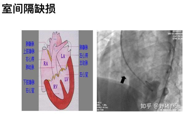 卵圆孔未闭房室间隔缺损是什么问题还能买保险吗