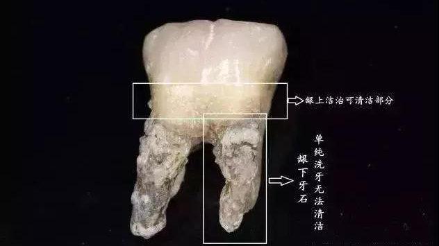 为什么人会长牙结石发现了一个可以不长的秘密