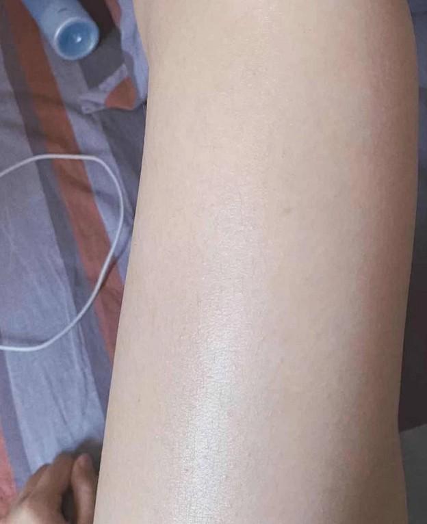 十年鸡皮肤对抗史