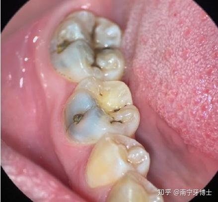 白色和米黄色的龋齿,说明龋坏的发展非常迅速,牙体几乎来不及染色就