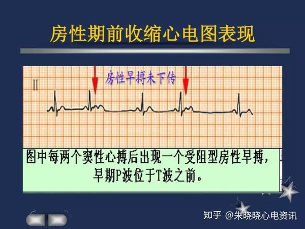 v5导联 对应口诀记忆: v1和v5,区分右和左,宽大为完束,高尖为室肥