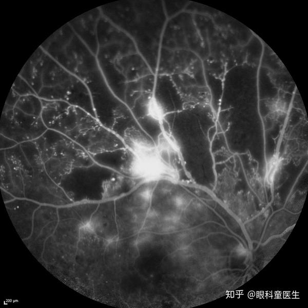 荧光素血管造影中显示亮的就是视网膜新生血管