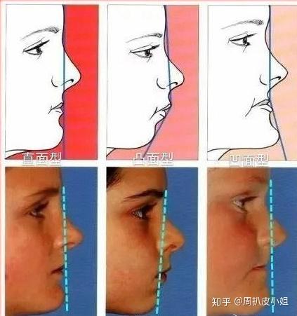 下颌角磨骨/截骨科普:面部轮廓审美标准,下颌角切多少才好看