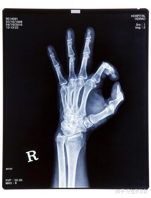 x光: 屏幕上意外看到自己手掌骨骼 惊呆物理学家
