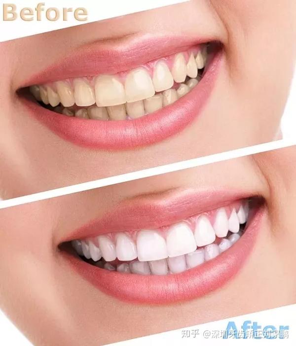 除了牙齿矫正,还有这些方法让你拥有一口漂亮美牙!