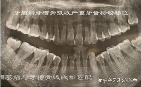 出现了牙周纤维破坏或牙槽骨吸