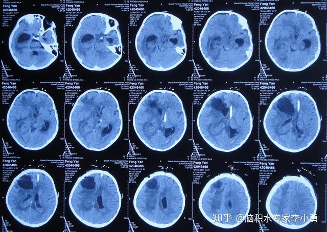 8岁男童7次脑室外引流和1次内镜三脑室底造瘘术后颅内感染性孤立颞角