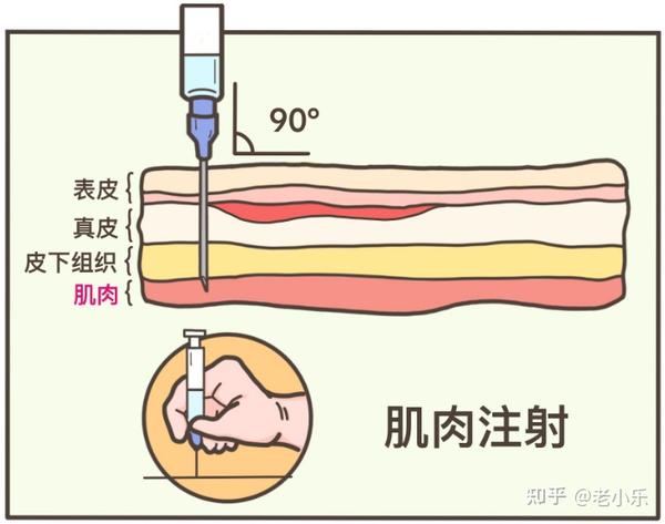4,肌肉注射,垂直进针最不疼