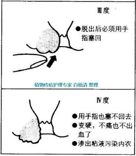 为啥有的痔疮疼有的痔疮不疼痔疮的最佳治疗方法是啥收藏