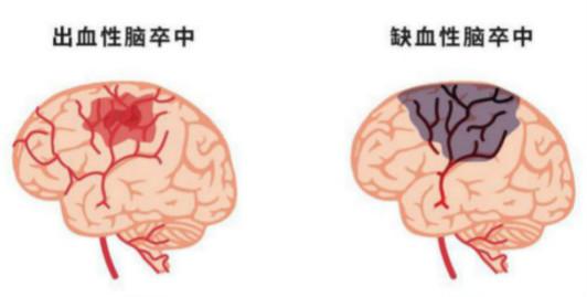 脑组织损伤的一组急性脑血管疾病,主要包括缺血性卒中和出血性卒中