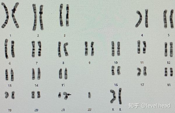 一条21号染色体与一条22号染色体罗伯逊易位核型图