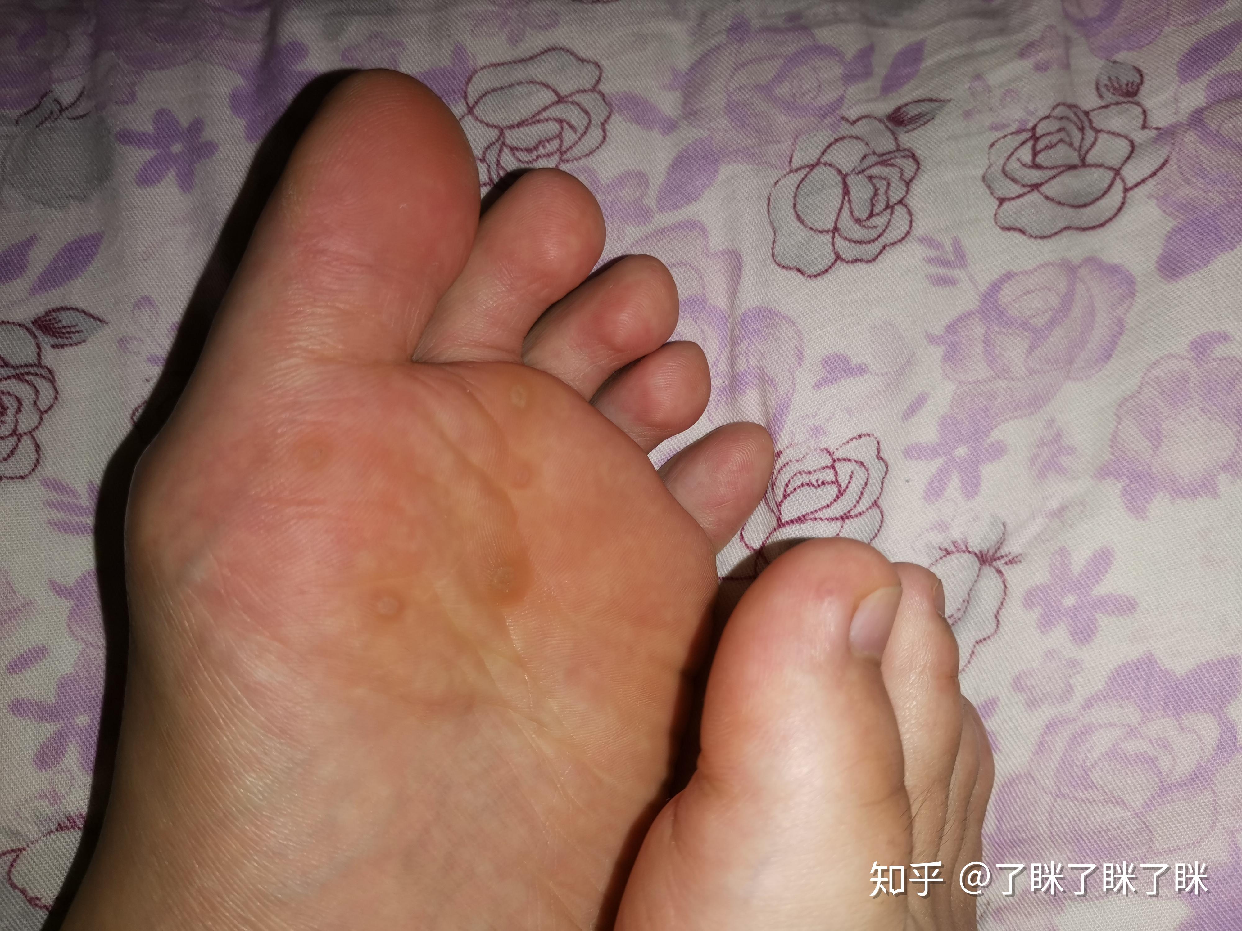 血泡刺 zhuanlan.zhihu.com