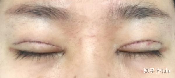 给想割双眼皮的姐妹们一些参考