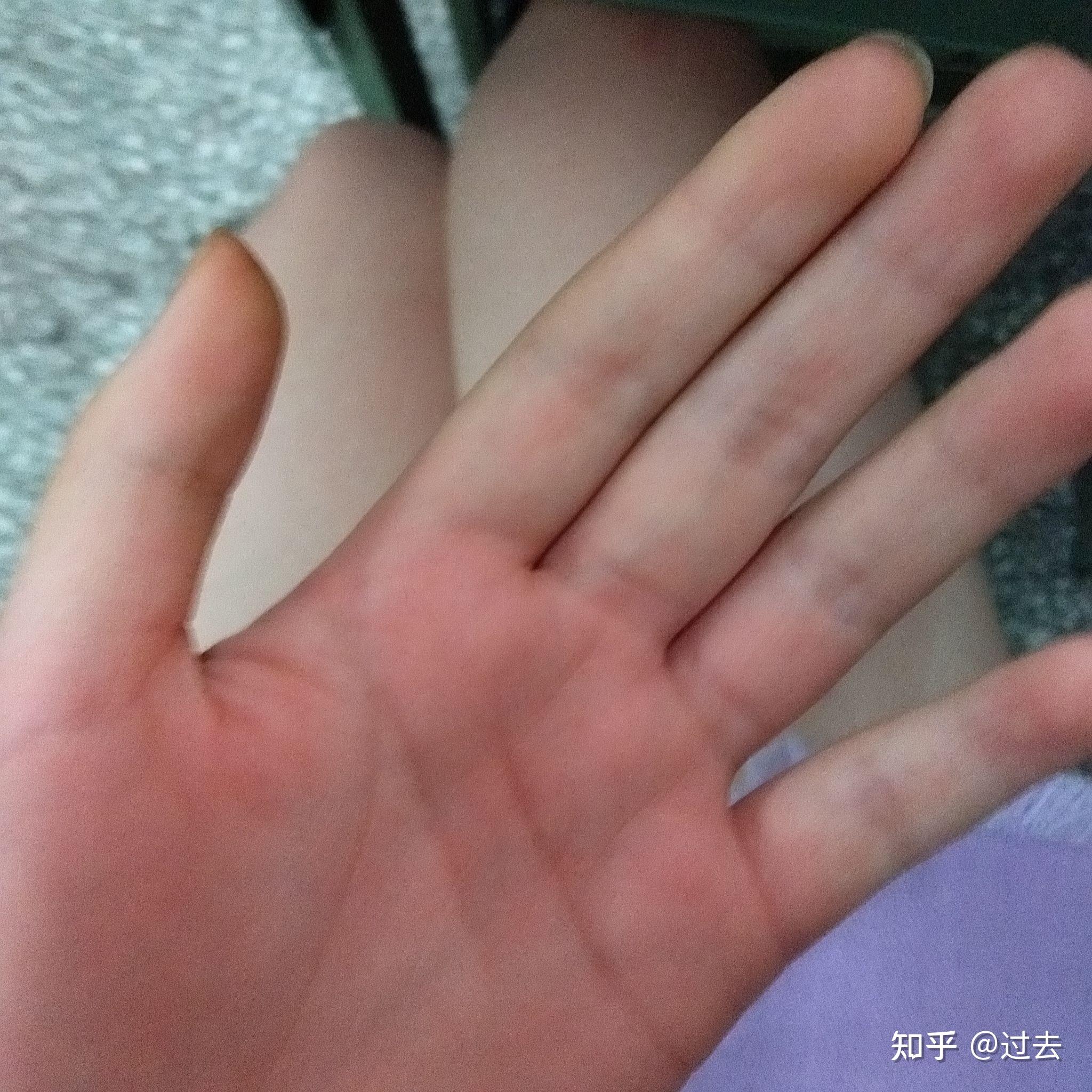 被打手心到肿是种怎样的体验
