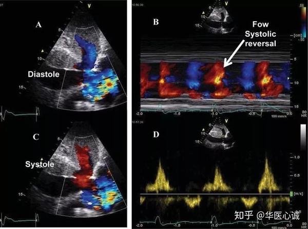 超声心动图十大基本功8.3:三尖瓣关闭不全的超声评估