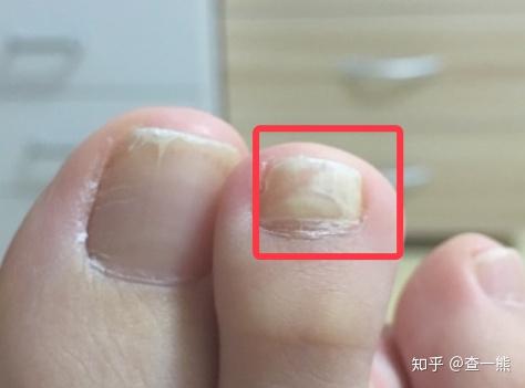 可参考症状图片: 【甲分离】:指甲前端或者指甲中间出现分离症状,指甲