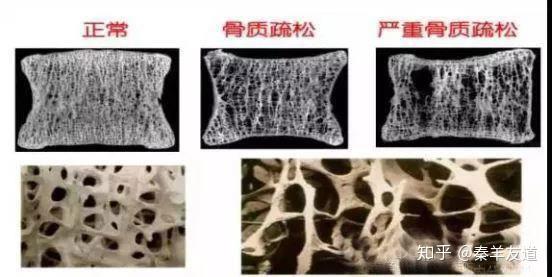 秦羊友道告诉老年人如何远离骨质疏松