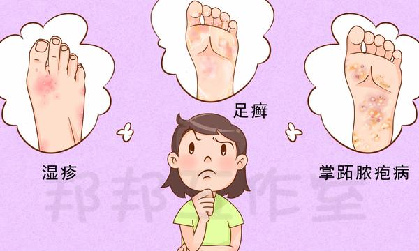 治"脚气"的几大误区,你中招了吗?