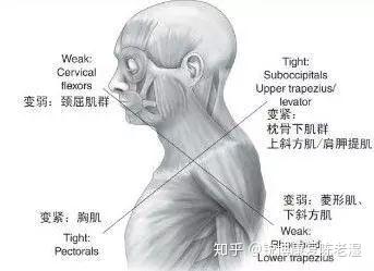 脖子前倾怎么矫正?