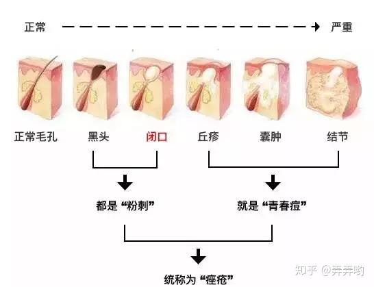 闭口怎么形成的?怎么去?