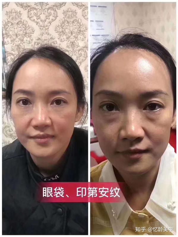 卧蚕,眼袋,傻傻分不清楚,忆龄molly老师告诉你区分二者的方法