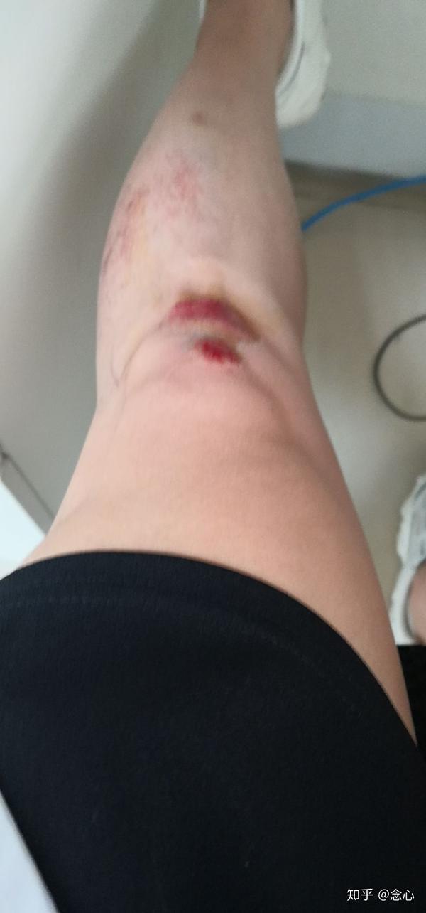 一年前骑电动车摔伤,擦伤腿.这是摔伤时候的照片.
