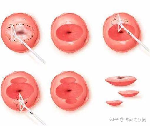 宫颈锥切术后多久复查?查什么?