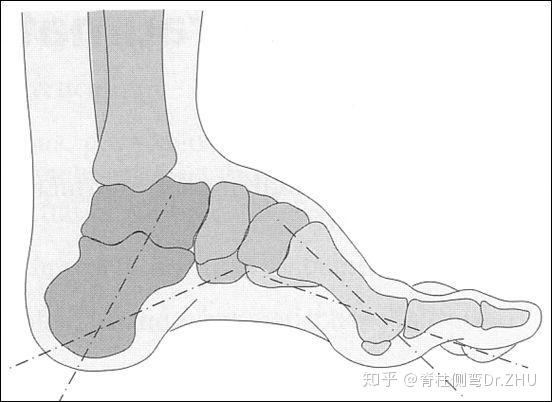 高弓足:扁平足就是人脚上的舟状骨,比正常人多长出一小块,拖到脚底下