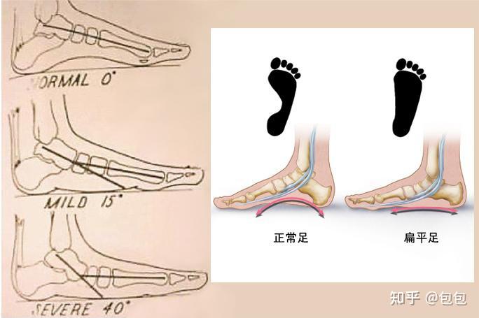 扁平足怎么办一文详解扁平足附康复方案