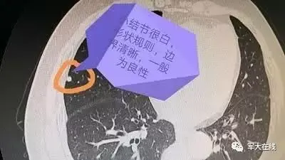 对此,由于切除整个肺叶将对患者的肺功能产生不可逆的损伤,因此肺部小图片