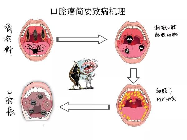 加之槟榔 释放的槟榔碱,两种因素共同作用下会导致 口腔粘膜下纤维化