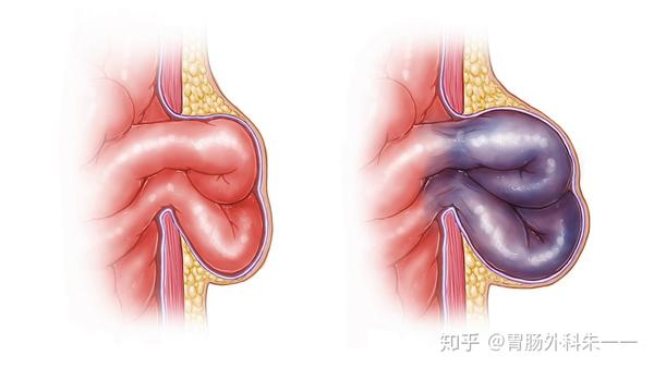 第一类家属 "我们不知道啊,老年人平时从来没有说过有疝气啊".