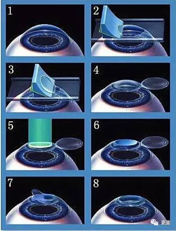 激光矫正近视眼原理是什么?是否有副作用?